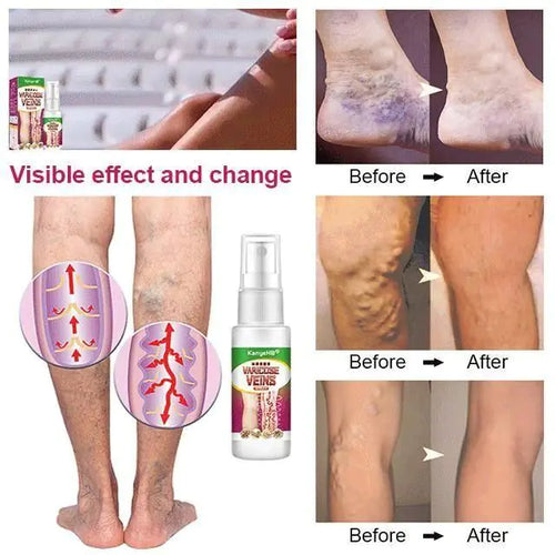 Load image into Gallery viewer, Varicose Veins Treatment Spray
