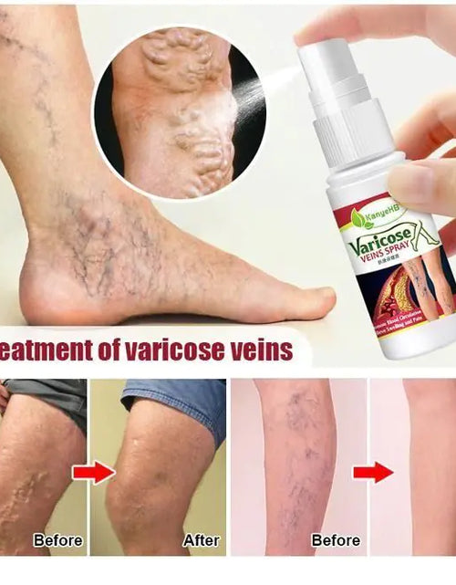 Load image into Gallery viewer, Varicose Veins Treatment Spray
