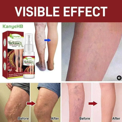 Load image into Gallery viewer, Varicose Veins Treatment Spray
